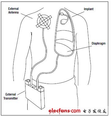 圖7,呼吸起搏器帶有用于膈神經刺激的植入電極以及RF接收器，還有向植入體發射RF信號的外部天線，完成刺激起搏功能